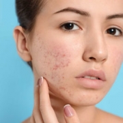 acne scars