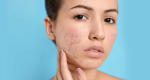 acne scars