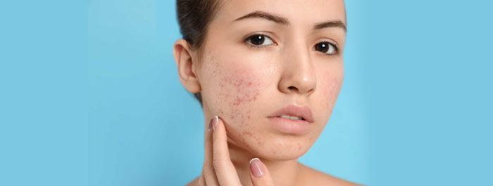 acne scars