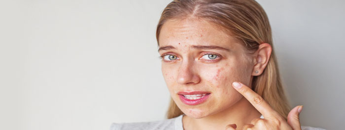 nodules and cystic acne